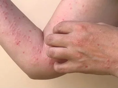 Salud Pública monitorea casos de viruela símica en destacamento de San Cristóbal